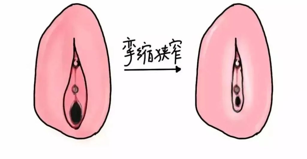 怎样判断自己得了外阴白斑