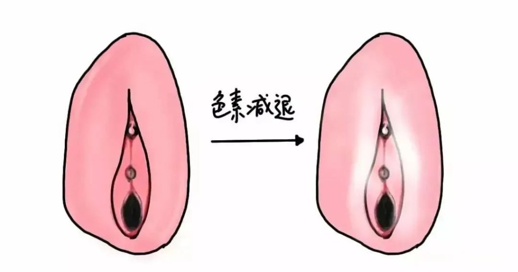 患上外阴白斑病后外阴皮肤颜色一定会变白吗？