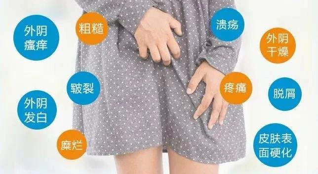 外阴白斑就是掉皮屑吗?