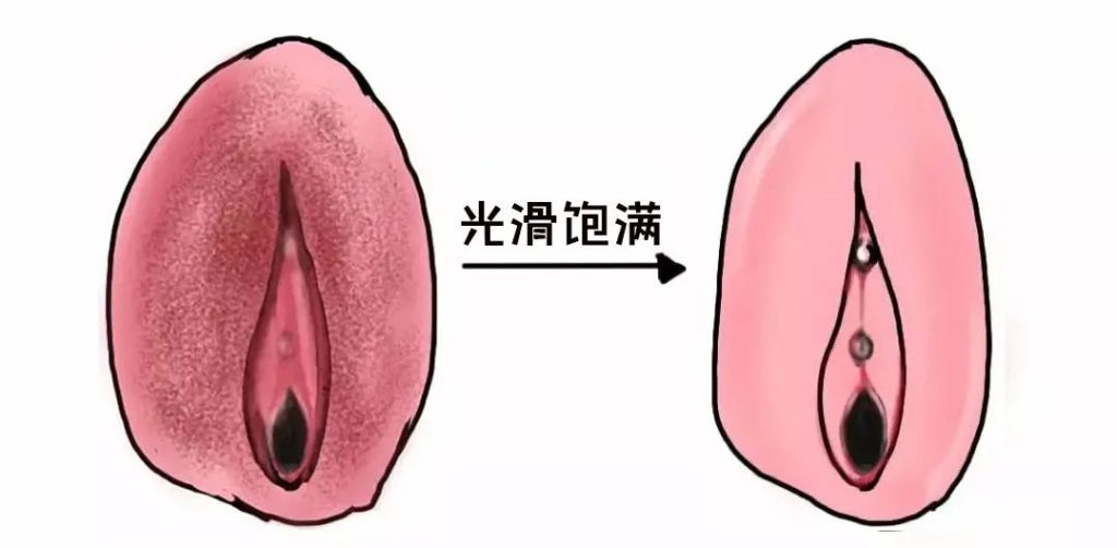 外阴白斑治愈的标准