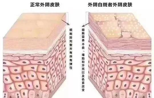 外阴白斑是性病吗?