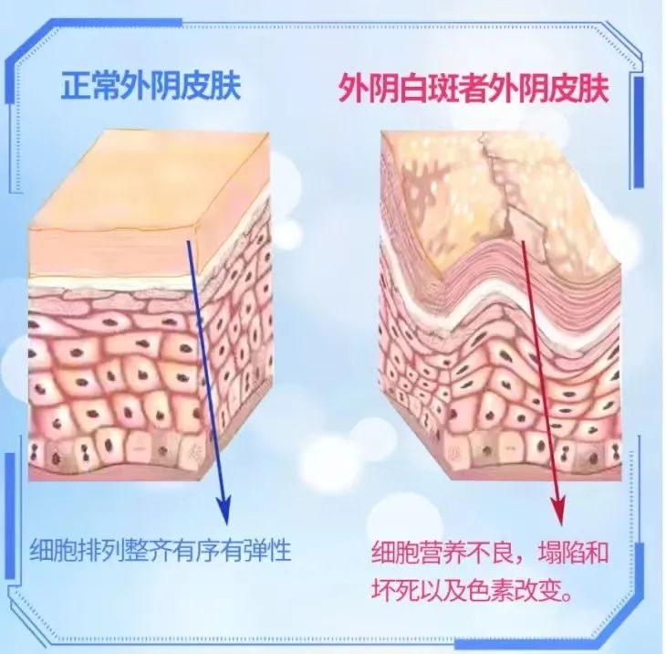 为什么不建议用激素药膏来治疗外阴白斑?